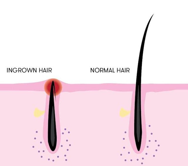 Body Facial Wash with Foam Brush - Anti Ingrown Hair Treatment | Intimate Care Solution