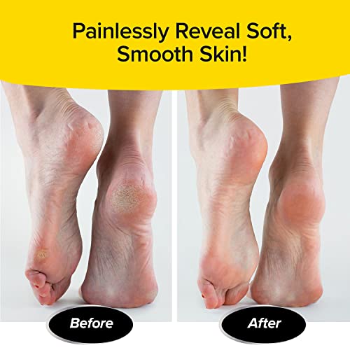 PedEgg Classic Callus Remover, As Seen On TV, New Look, Safely & Painlessly Remove Tough Calluses Dry Skin to Reveal Smooth Soft Feet, 135 Precision Micro-Blades, Traps Shavings