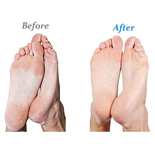 Emjoi Micro-Pedi Ultra Callus Remover (Pink)