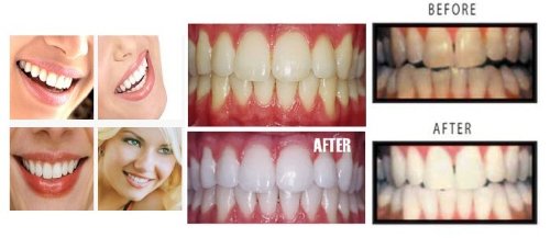 Teeth Whitening Gel - 38% Carbamide Peroxide for Fast Results | Sensitivity-Free, Dentist Recommended, 5 XL