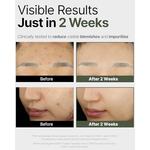 Trouble Patch Mask ? Full-Face Acne & Sebum Control Korean Sheet Mask with Tea Tree Biome, Hydrocolloid-Inspired Care for Oily Skin, Visible Sebum Lift, Holiday Skincare Gift | 20ml x 4