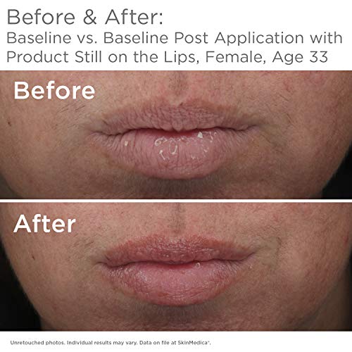 SkinMedica HA5 Smooth & Plump Lip System - Your Hydrating, Volumizing Lip Plumper for Visibly Fuller and Smoother Lips, 0.05 Oz