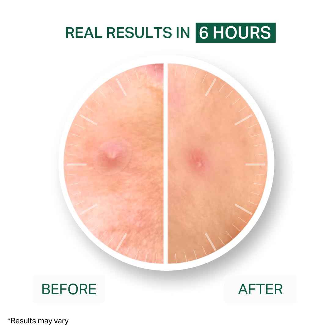 Y’OUR Improving Acne Patches: Ultra-thin Hydrocolloid Pimple Patch for Face; Purifies & Alleviates Stubborn Blemishes, Promotes Healing, Effective Zit Treatment. Made in USA. 56 Count