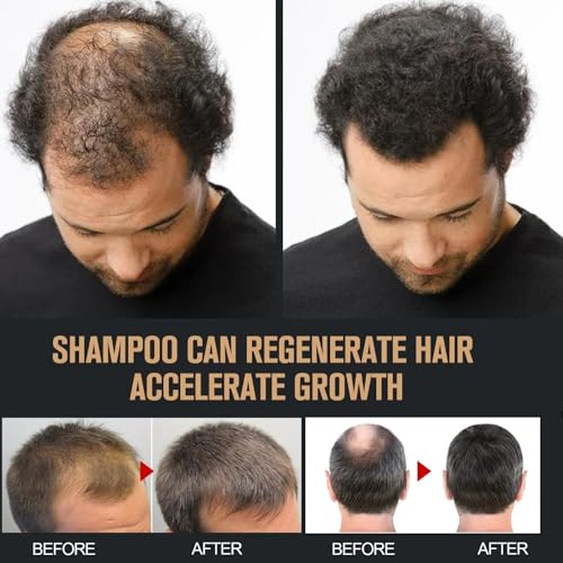 2 Pcs Root Activator Shampoo, Hair Growth Root Activator Shampoo, For Anti-Hair Loss, Natural Formula for Men and Women