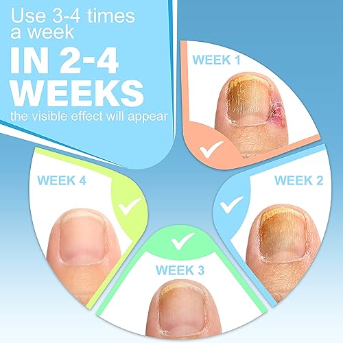 Ingrown Toenail Treatment w/Ingrown Toenail Drops Reliever & Softener,Double Sided Pedicure Nail Lifter Tool for Easy Trimming Care Thick Nail & Ingrown Toe Nail,Toenail Cleaner Kit for Men Women