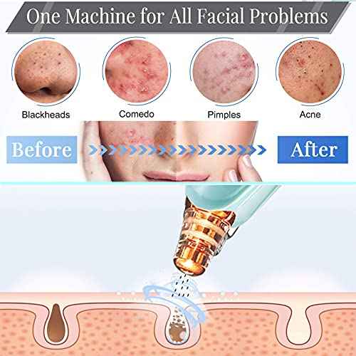 Blackhead Remover Pore Vacuum Cleaner - Upgraded Facial Pore Cleaner - Electric USB Pore Vacuum with 5 Probes - Upgraded Blackhead Suction Tool - Blackhead Remover Kit
