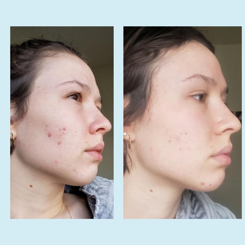 Glycolic Acid 50% Gel Peel - Enhanced with Retinol & Green Tea Extract (Professional Skin Peel)1 ounce
