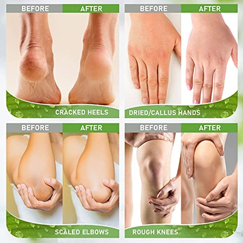 Urea Cream 42% with 2% Salicylic Acid, Callus and Dead Skin Remover, Deeply Moisturize, Repair Dry, Cracked, Rough Skin of Heel, Elbow and Knee, Effective Urea Foot Cream(7oz)
