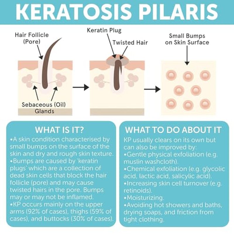 KP Bump Eraser Body Set | Keratosis Pilaris Treatment | Keratosis Pilaris Lotion | Exfoliating Body Scrub | Ingrown Hair Treatment | Bundle Set for Bump, Strawberry Legs, Redness, Dry & Flakey Skin