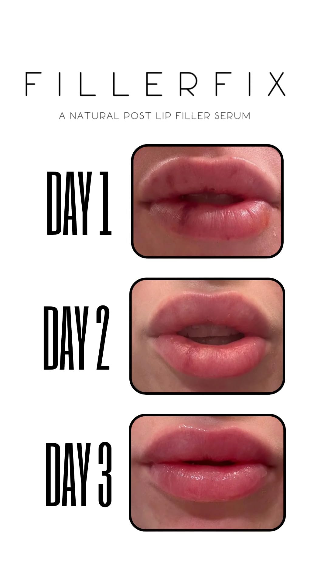 FillerFix Arnica Lip Balm for Lip Filler Aftercare – Organic Lip Serum with Cooling Ceramic Tip – Arnica & Calendula Lip Treatment