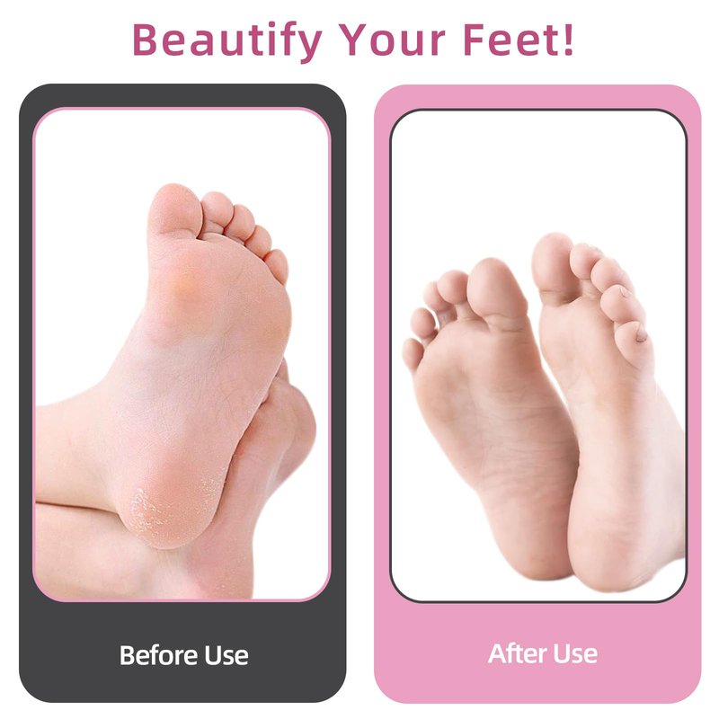 APRELM Electric Foot Callus Remover with 80pcs Sandpaper Discs, 4.8IN Longer Professional Callus Remover for Feet, Pedicure Tools Foot File for Dead Skin