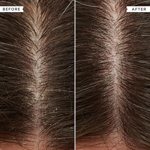 Flaky Scalp Shampoo and Conditioner Set for Dry Scalp Cleansing Hair Products Soothing, Soothes and Calms