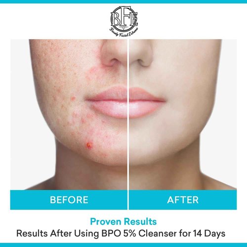 Acne Face wash Treatment with Benzoyl Peroxide 5% - Fight Acne Blemishes on Contact for Cystic Breakouts, Oily Skin, Clogged Pores, Blackhead, Whitehead & Pimples. Achieve Clear Skin.