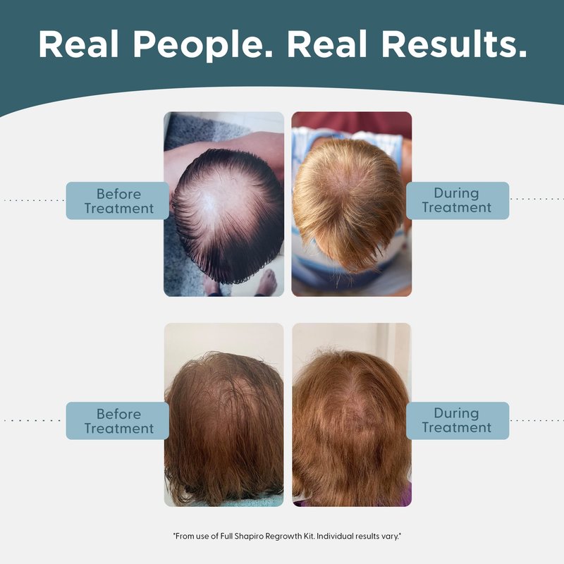 Shapiro MD Hair Growth Experts Mens Regrowth Travel Kit: Leave-In Foamer, 5% Minoxidil. Achieve Thicker, Fuller and Healthier Looking Hair, 1 Month Supply