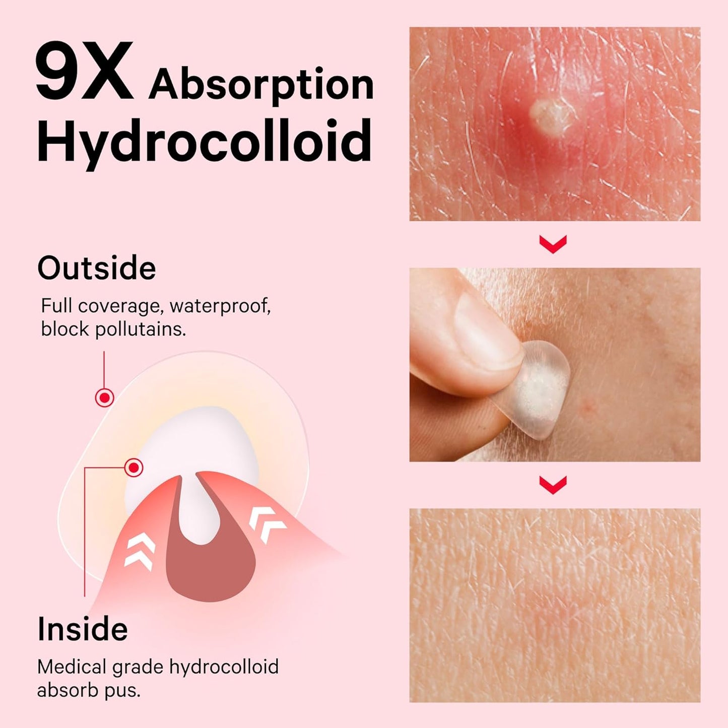 Sosky Pimple Patches for Face, Invisible Hydrocolloid Acne Patches, HSA Store Eligible Items, Zit Sticker for Face and Skin, Pimple Sticker for Covering Zits, Blemishes with Salicylic Acid 48 Count