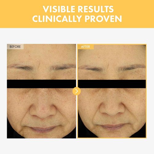 TOSOWOONG Eraser Liquid Patch with Niacinamide, Tranexamic Acid and Centella Asiatica Extract, 15g, 0.52 oz.