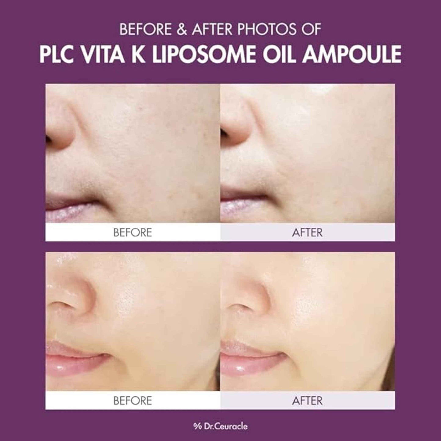 Dr.Ceuracle PLC Vita K Liposome Oil Ampoule - Post Laser Care with Vitamin K, Glowing Serum for Uneven & Dull Skin, Korean Skincare (50 ml / 1.69 fl. oz.)