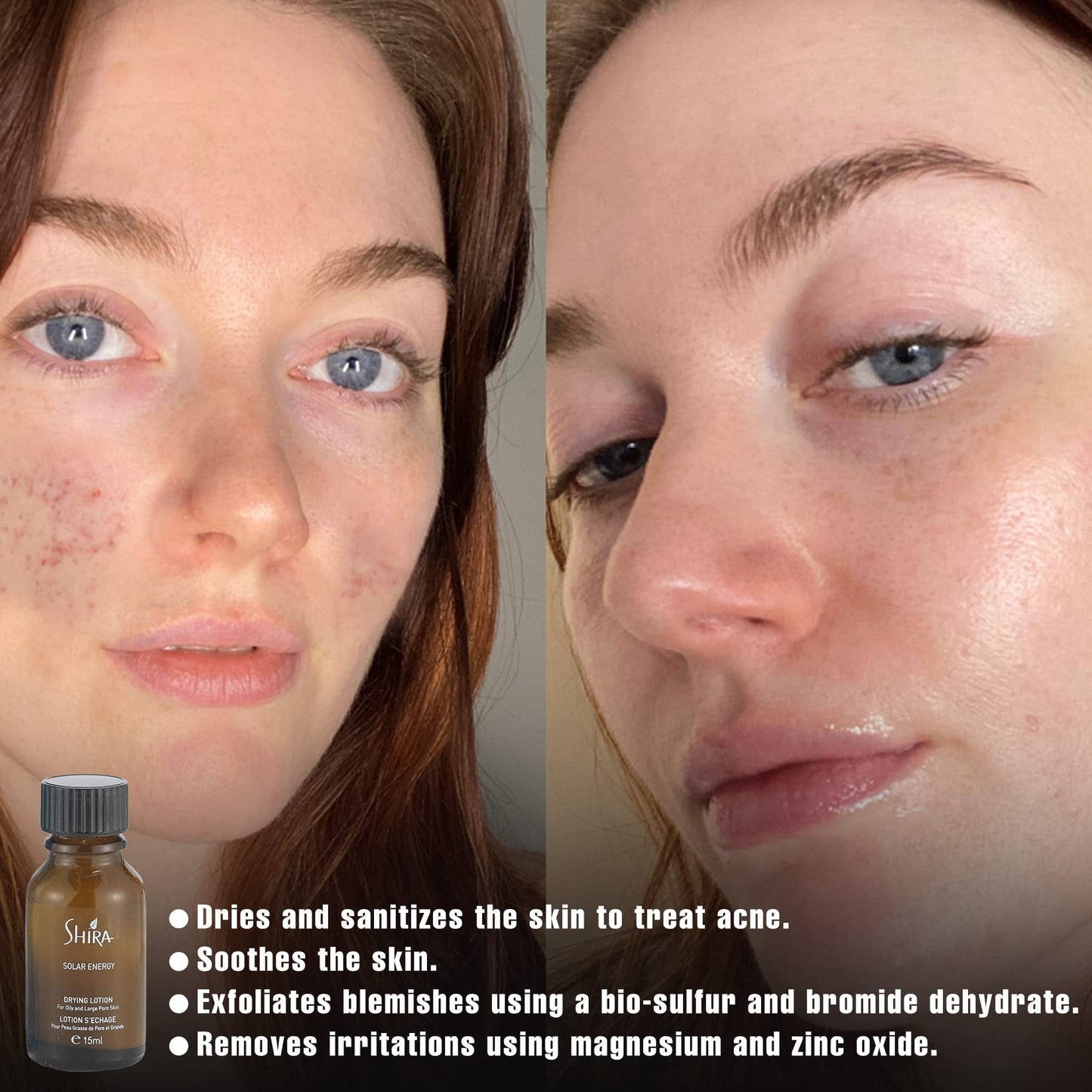 Shira Solar Energy Drying Lotion Acne & Oily Skin, Effective Acne Spot Treatment for All Skin Types,Safe Lotion for Pimple Spot Treatment(15ml)