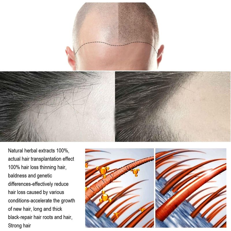 Hair Regrowth System, Advanced Hair Growth Treatment Ginseng, Eclipta Prostrata, Peppermint Oil and Ginger Root, Treatment for Thicker, Strengthens Roots,for Men and Women 1pcs