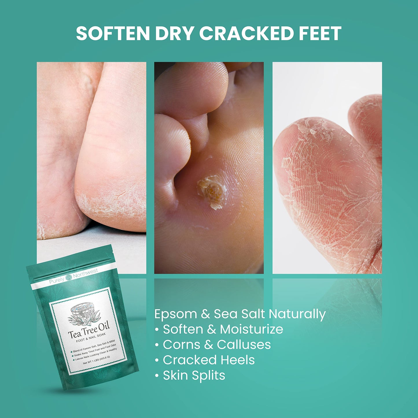 3 Pounds-Tea Tree, Peppermint, Foot Soak | MSM with Epsom Salt Soothes Burning & Itching from Athletes Foot & Foot Odors-Softens Dry Calloused Heels Made by Purely Northwest