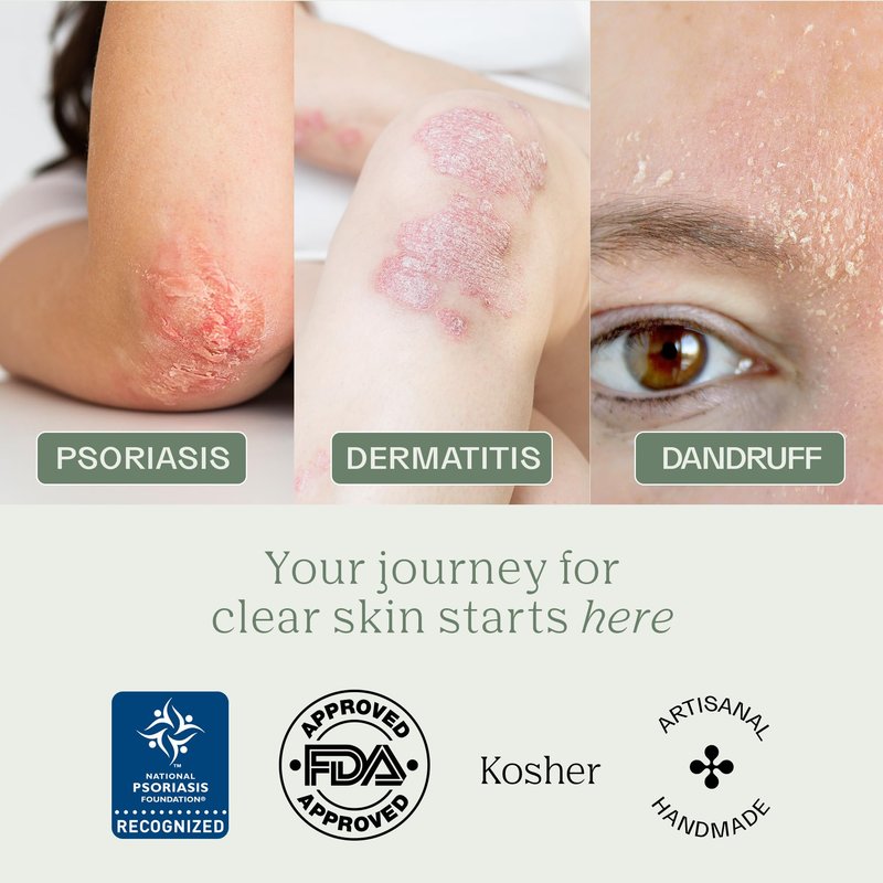 Dermabon Psoriasis, Dermatitis & Dandruff Control Soap Bar with 2% Coal Tar as Active Ingredient for Eczema Relief - 1 Pack