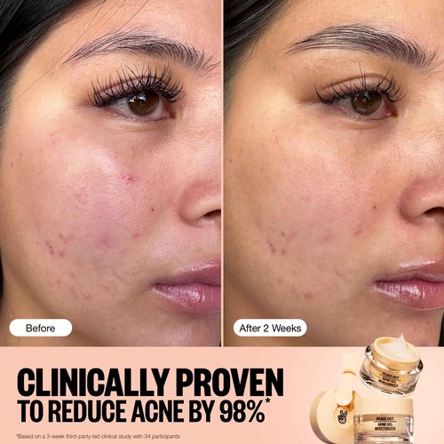 PEACE OUT Skincare Acne Gel Moisturizer, For Daily Facial Use with Salicylic Acid & Niacinamide, Boost Hydration and Help Prevent Acne & Blackheads, for Men & Women, 1.69 fl oz