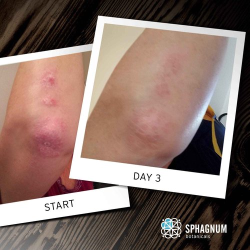 Sphagnum Botanicals Psoriasis Body Wash – Peat Mud and Olive Oil for Dry & Itchy Skin. 8.45 oz