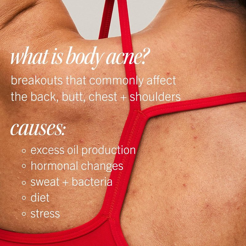 Body Acne Spray - Fast-Acting Treatment for Clear Skin | 6 oz