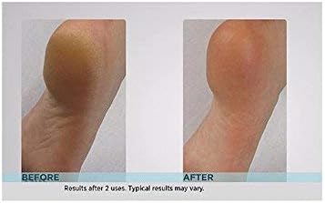 Emjoi Micro-Pedi Callus Remover - Effective Foot Care Tool w/Bonus Rollers | Turquoise