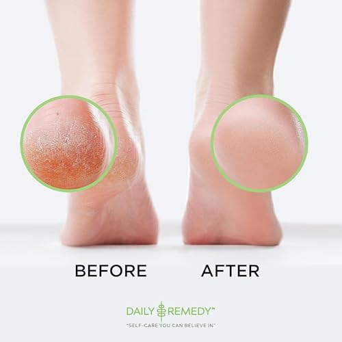 Foot Callus Remover Gel Set - Professional Callus Remover for Feet, Calloused Feet Remover Gel - Pedicure Kit & Foot Spa Tools - Feet Callus Remover - 8oz w/ 16oz Tea Tree Oil Foot Soak - USA