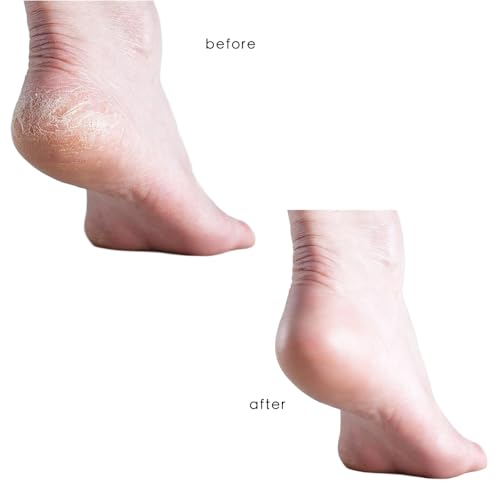 6 Pack Foot Pumice Stone for Feet Callus and Foot Scrubber Dead Skin Remover (Blue)