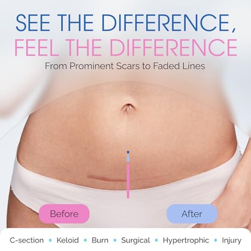C Section Scar Silicone Strips for Surgical Scars, Tummy Tuck, and Postpartum Recovery - Tape for Scars - Reusable Silicone Scar Sheets - C Section Recovery Must Haves - Large 7-Inch Size, 8-Pack