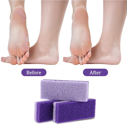 6pcs Foot Stone Pumice,Heel Scrubber,Foot Pumice Stone for Feet Skin Callus Remover and Scrubber£¨Purple£©