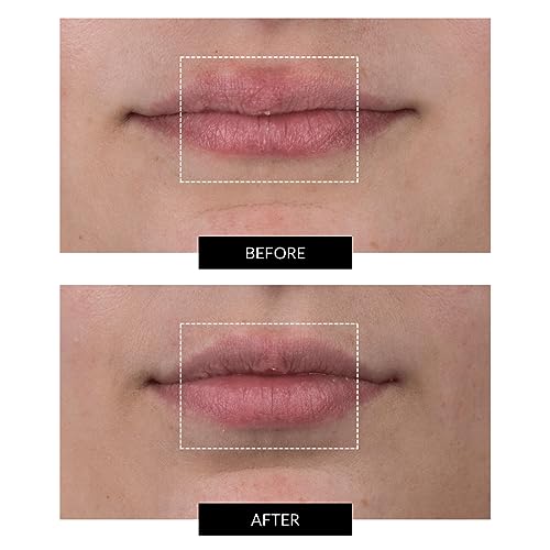 CurrentBody Skin LED Lip Perfector | Fully Wearable Anti-Aging Device for Lips | Soften Feather and Smile Lines for Plumper and Fuller Lips