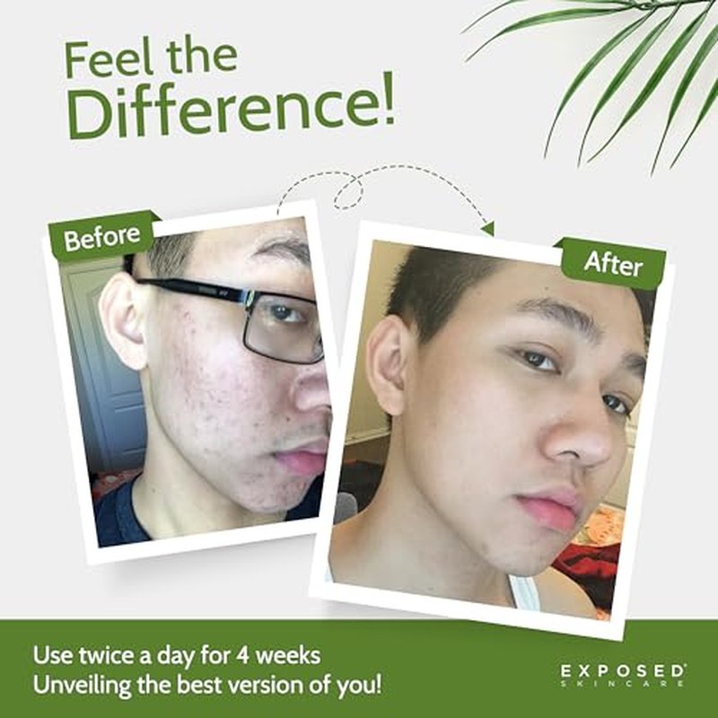 Exposed Skin Care, Acne Treatment Kit with 2.5% Salicylic Acid and 3.5% Benzoyl Peroxide to Clear Up Teen, Adult, Hormonal and Cystic Acne ? Natural, Non-toxic and Cruelty Free