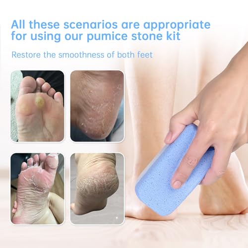 Glass Pumice Stone for Feet Callus Remover?4-in-1 Foot Scrubber Kit with 2 Bigger Dual-Sided Foot Pumice Stones, Cone Foot Exfoliator, Nail Brush for Cleaning Fingernails ?Blue &White