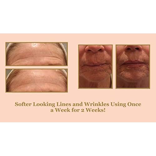 DIAMONDBUFF Microderm Exfoliation Tool for at Home Glowing and Radiant Skin | Reduce Acne, Fine Lines, Wrinkles, & Provide a Velvety Smooth Complexion with Diamond Microdermabrasion