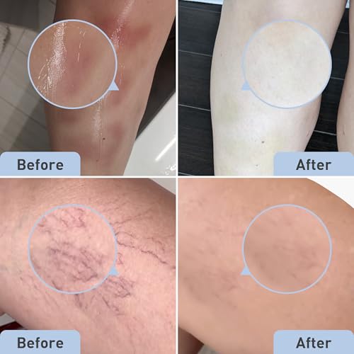 Procure Bruise Remedy