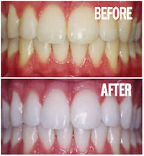 Teeth Whitening Gel Refill Kit - 10 Tubes 44% Carbamide Peroxide | Bright White Smiles
