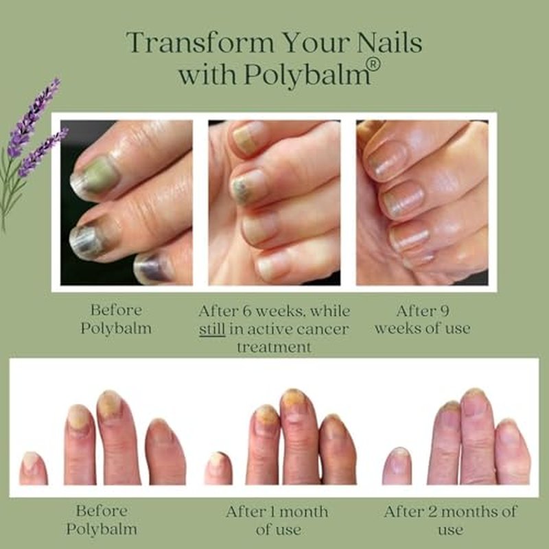 CHEMO NAIL PROTECTION | Clinically Proven & Doctor-Developed Oncology Supportive Care | 100% Natural | Strengthen & Repair Nails Damaged by Chemotherapy & Breast Cancer| Nail Toxicity Support| UK Made