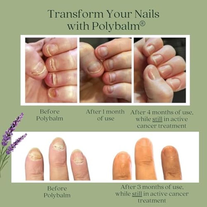 CHEMO NAIL PROTECTION | Clinically Proven & Doctor-Developed Oncology Supportive Care | 100% Natural | Strengthen & Repair Nails Damaged by Chemotherapy & Breast Cancer| Nail Toxicity Support| UK Made