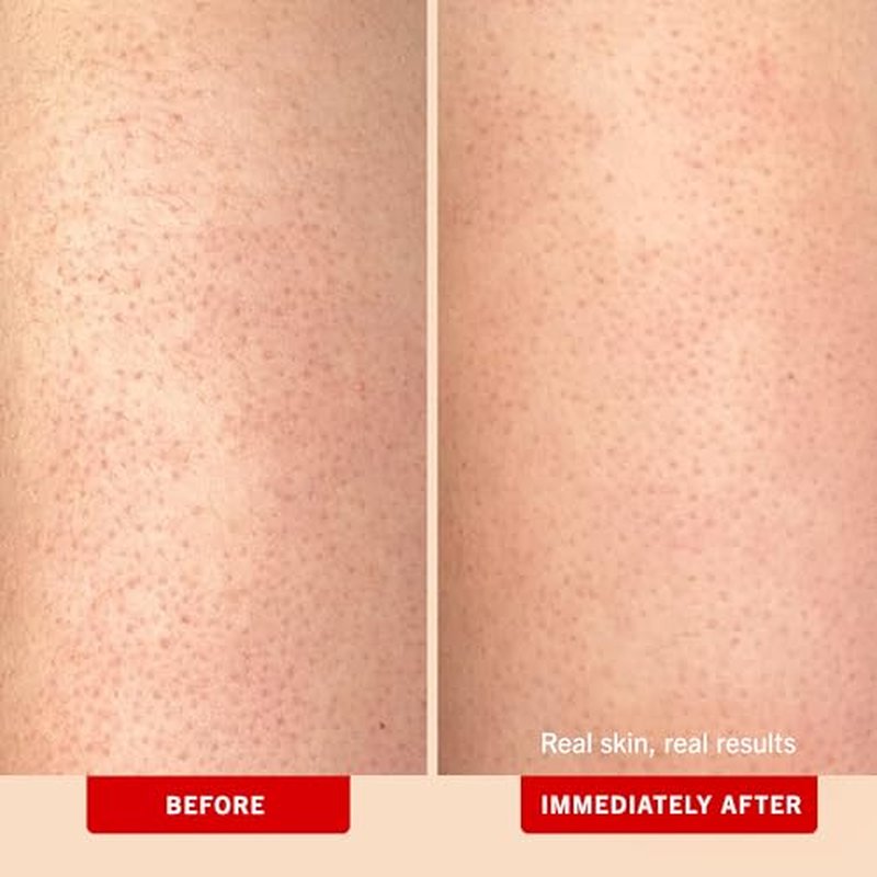 First Aid Beauty - KP Bump Eraser Body Scrub with 10% AHA, Keratosis Pilaris Exfoliator with Glycolic and Lactic acids, Helps Reduce Chicken Skin Bumps, Safe for Sensitive Skin, Peach Scent (8 oz)