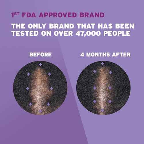 Rogaine 5% Minoxidil Foam, Topical Once-A-Day Hair Loss Treatment for Women to Regrow Fuller, Thicker Hair, Unscented, 2-Month Supply, 2.11 oz