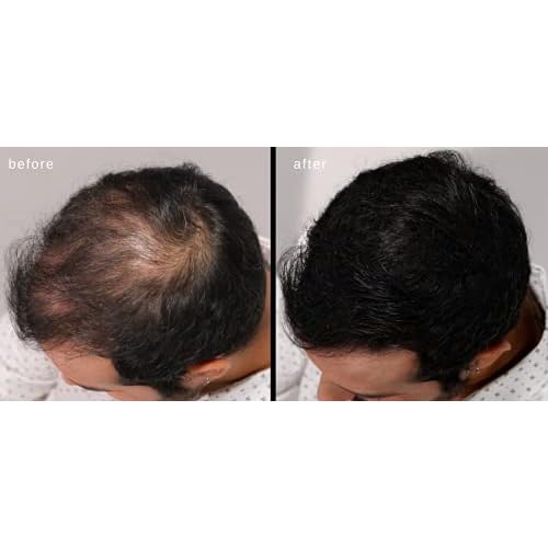 LUXE Hair Building Fibers - Thickening Fibers - CONFIDENCE IN A JAR ? 2 Months+ Supply! ? Hypoallergenic, Dermatologist Tested ? Multiple Colors Available (Dark Brown)