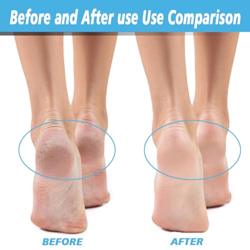 4 Pack Extra Coarse Green Replacement Roller Refills Compatible with Scholl Express Pedi Foot Smoother