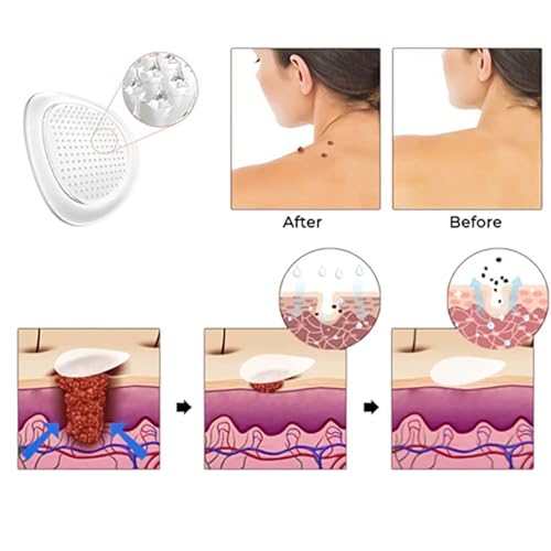 KUBOZN Pro MicroDarts Patch, Hydrocolloid with Salicylic Acid, 144 Count, Invisible Blemish Cover (1Box)