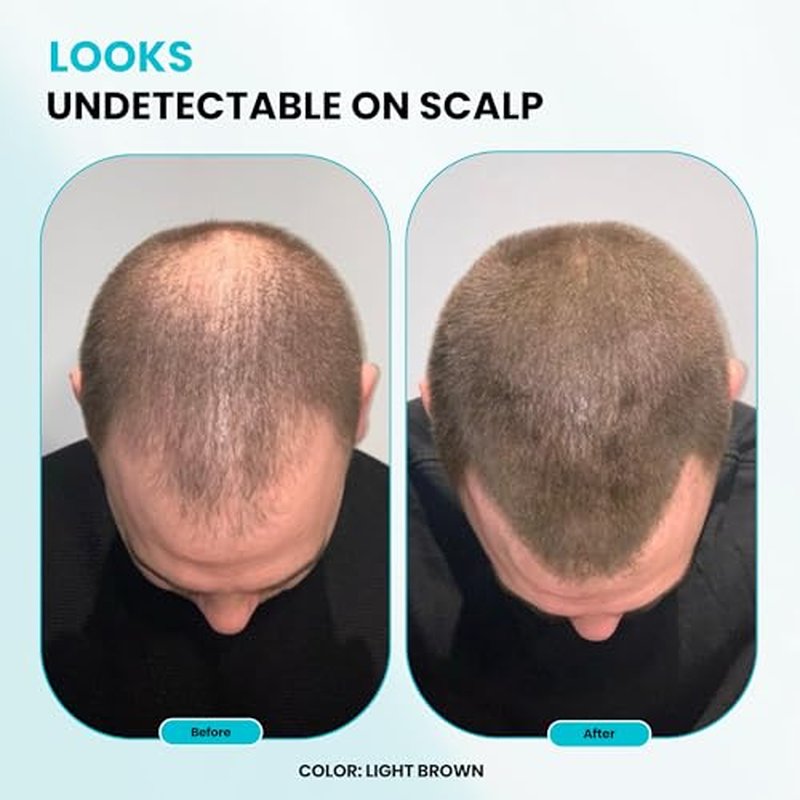 SURETHIK Hair Fibers, 30g (Dark Brown), Fills Thinning Hair for Visibly Fuller Look, Conceals Bald Spots, Natural Look, For Men & Women