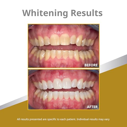 Opalescence 45% Syringes Teeth Whitening Gel - with PF - (4 Syringes) Refill Kit Carbamide Peroxide. w/Toothbrush, in Mint Flavor. Tooth Whitening 5359-2T