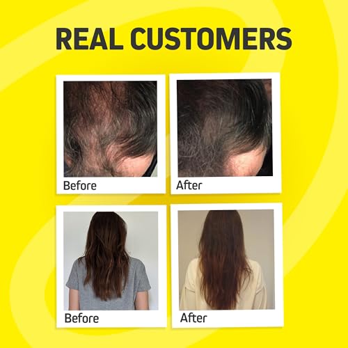 Hair Growth Vitamins for Women & Men | DHT Blocker with Saw Palmetto & 10000mcg Biotin, Foli Tonic Hair Growth Supplement ? Supports Fuller, Thicker Hair Appearance, Non-GMO, 60 Vegan Capsules