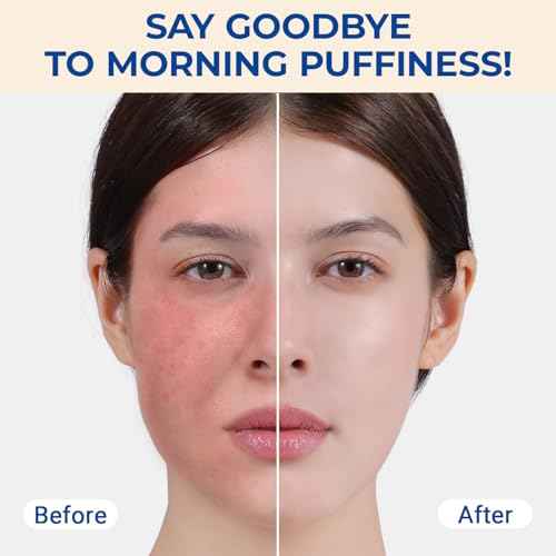 MORGLES Ice Roller for Face, Professional Face Roller Cryotherapy Tool to Reduce Puffiness, Redness & Headaches, Tighten Skin and Improve Lymphatic Drainage with Ergonomic Handle (Pink)